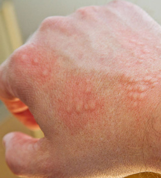 An allergic reaction to the avenin in oats